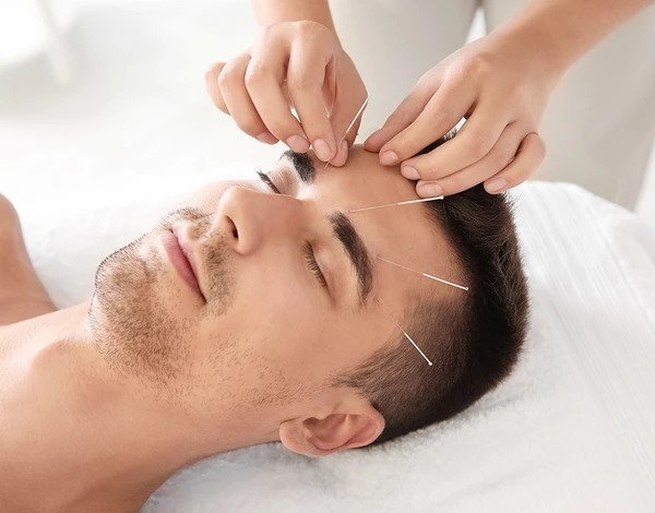 Acupuncture in Calgary, facial acupuncture, acupuncture treatment