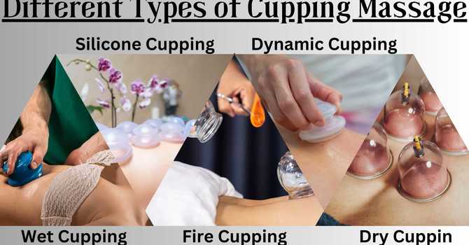  Exploring the Diverse World of Cupping Massage: A Look at Various Techniques and Methods image
